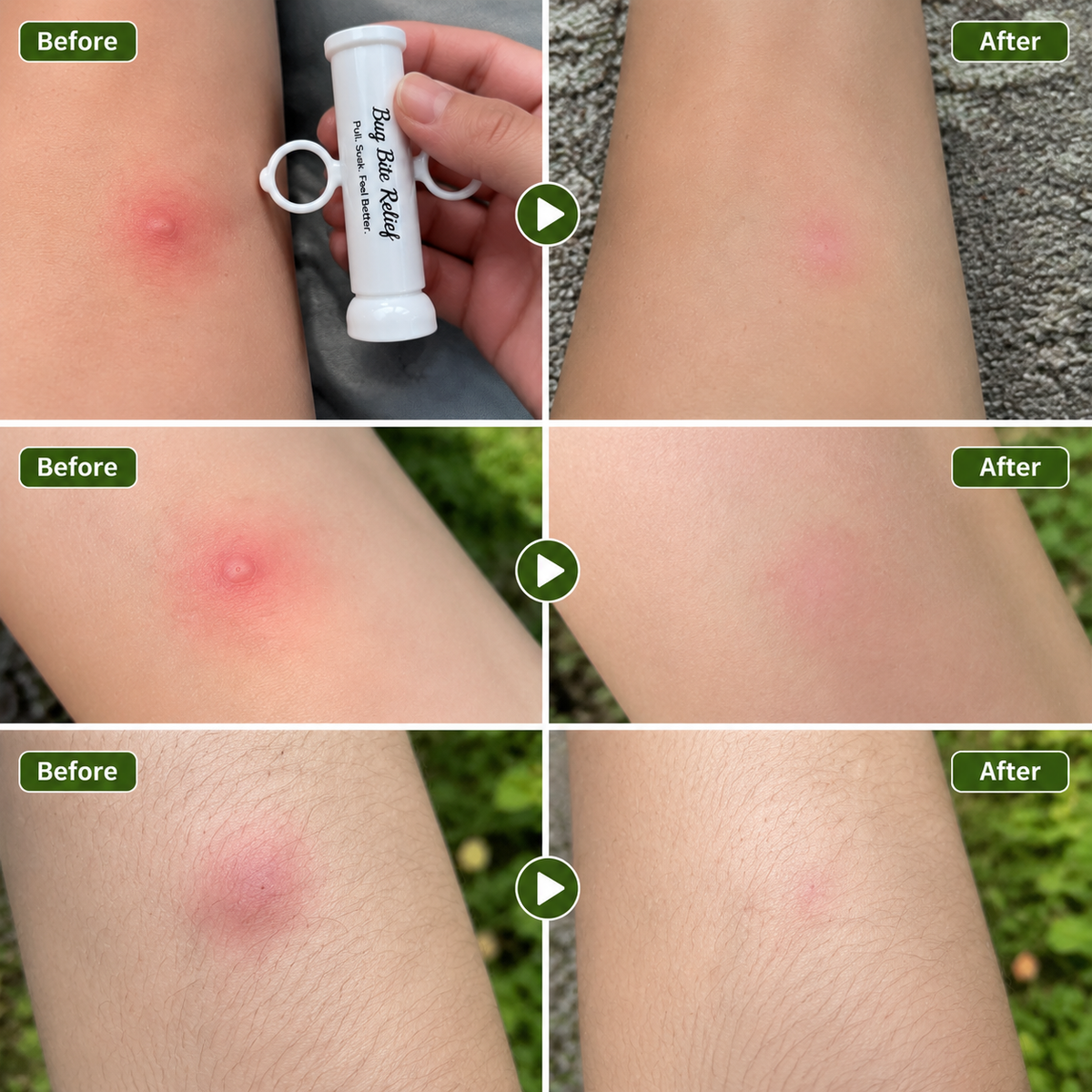 Bug Bite Thing Suction Tool,Poison Remover
